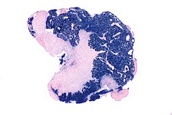 Imagen ilustrativa de Carcinoma Nasofaríngeo