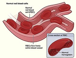 Imagen ilustrativa de Anemia Hemolítica: Causas, Síntomas y Clasificación