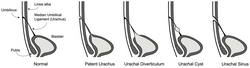 Imagen ilustrativa de Seno Umbilical-Uracal: Causas, Síntomas y Tratamiento