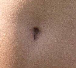 Ombligo en forma de T